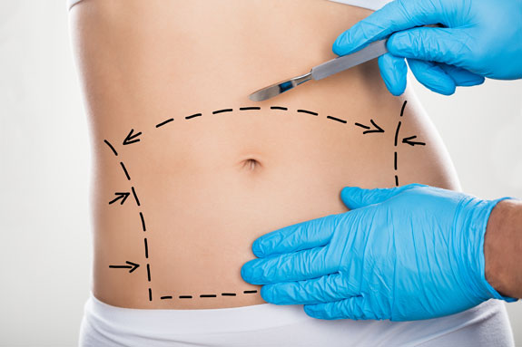 Abdominoplastik Goslar
